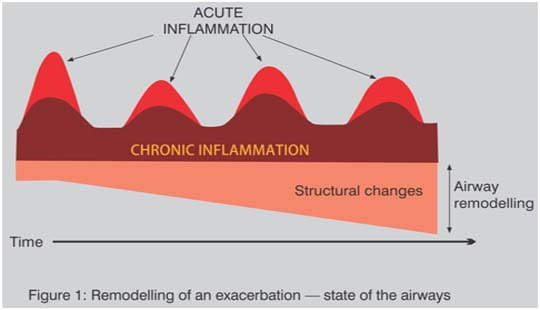 asthma_exa_7