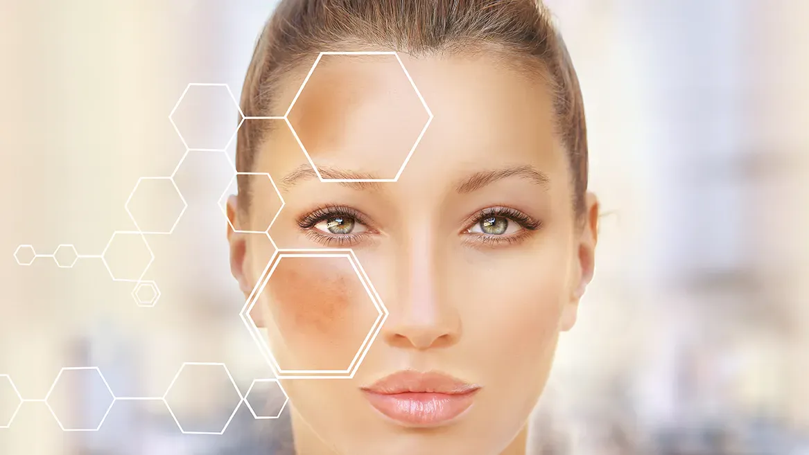 Hyperpigmentation3
