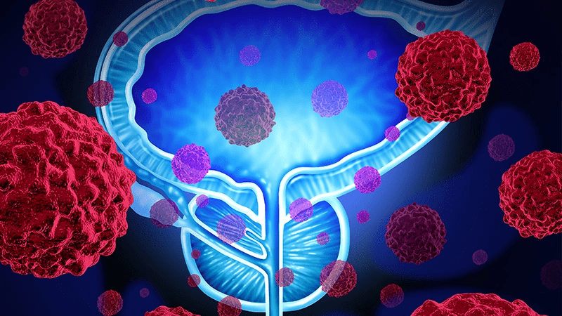 Prostate_cancer_3