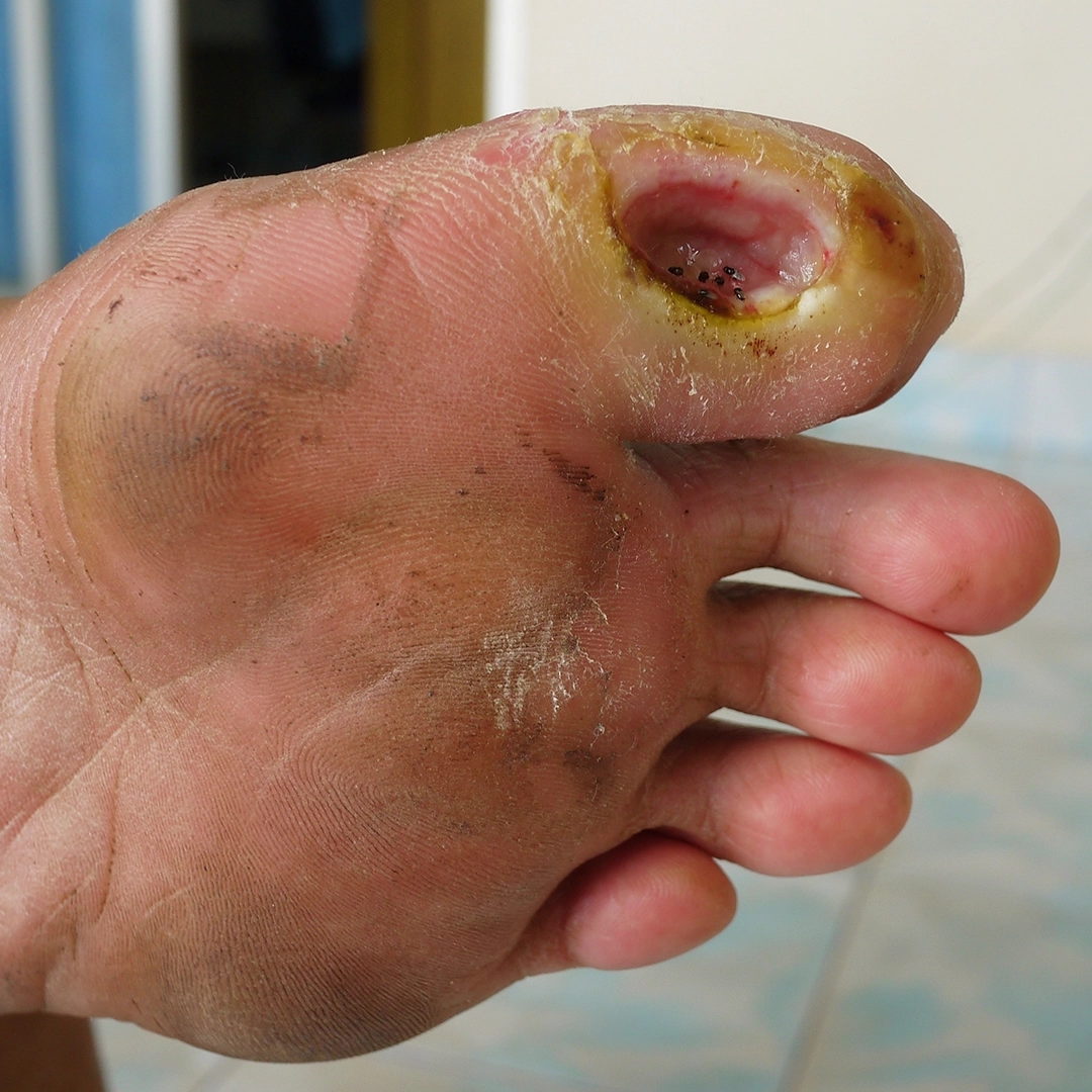 Novel Antibiotics for the Management of Diabetic Foot Infection