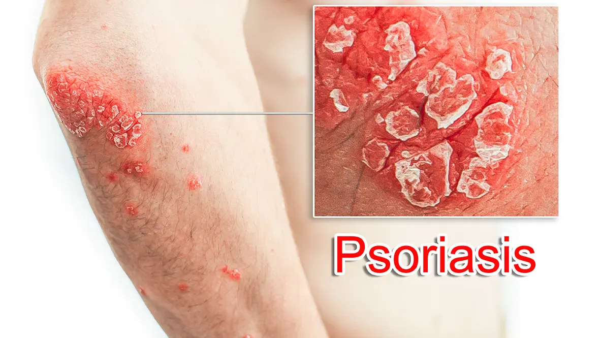 Psoriasis