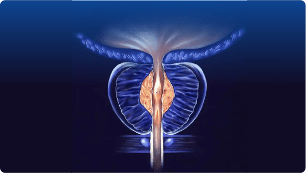 Befikr Zindagi Visual Prostate Symptom Score VPSS